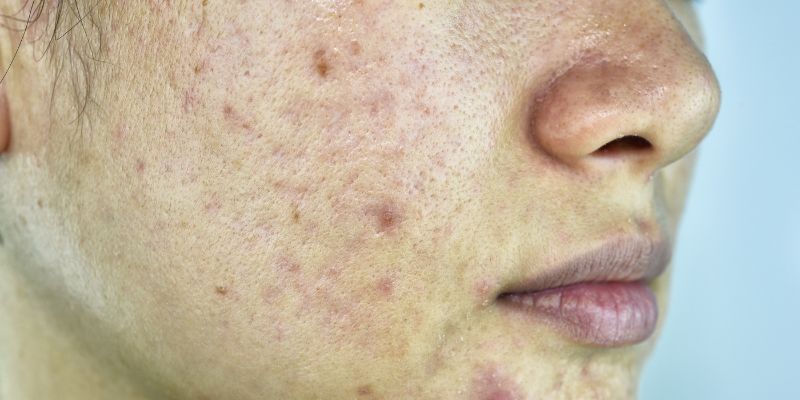 Acne Redness: Treatments, Causes & Tips