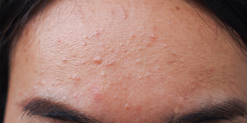 fungal acne on face