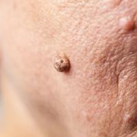 skin tag removal