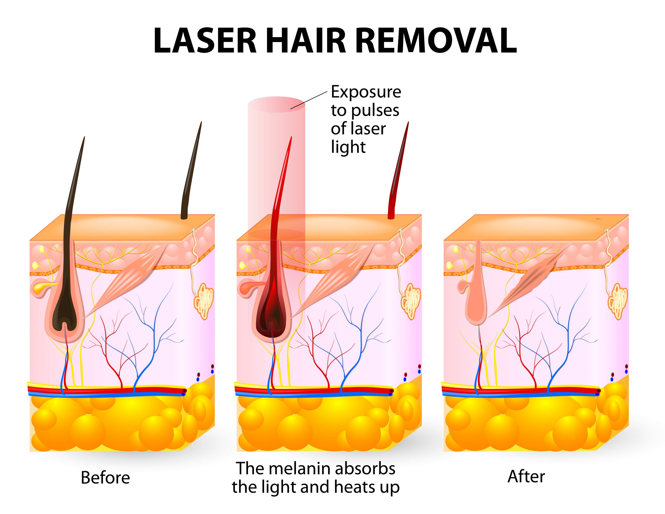 Laser Hair Removal  Medical Day Spa of Chapel Hill