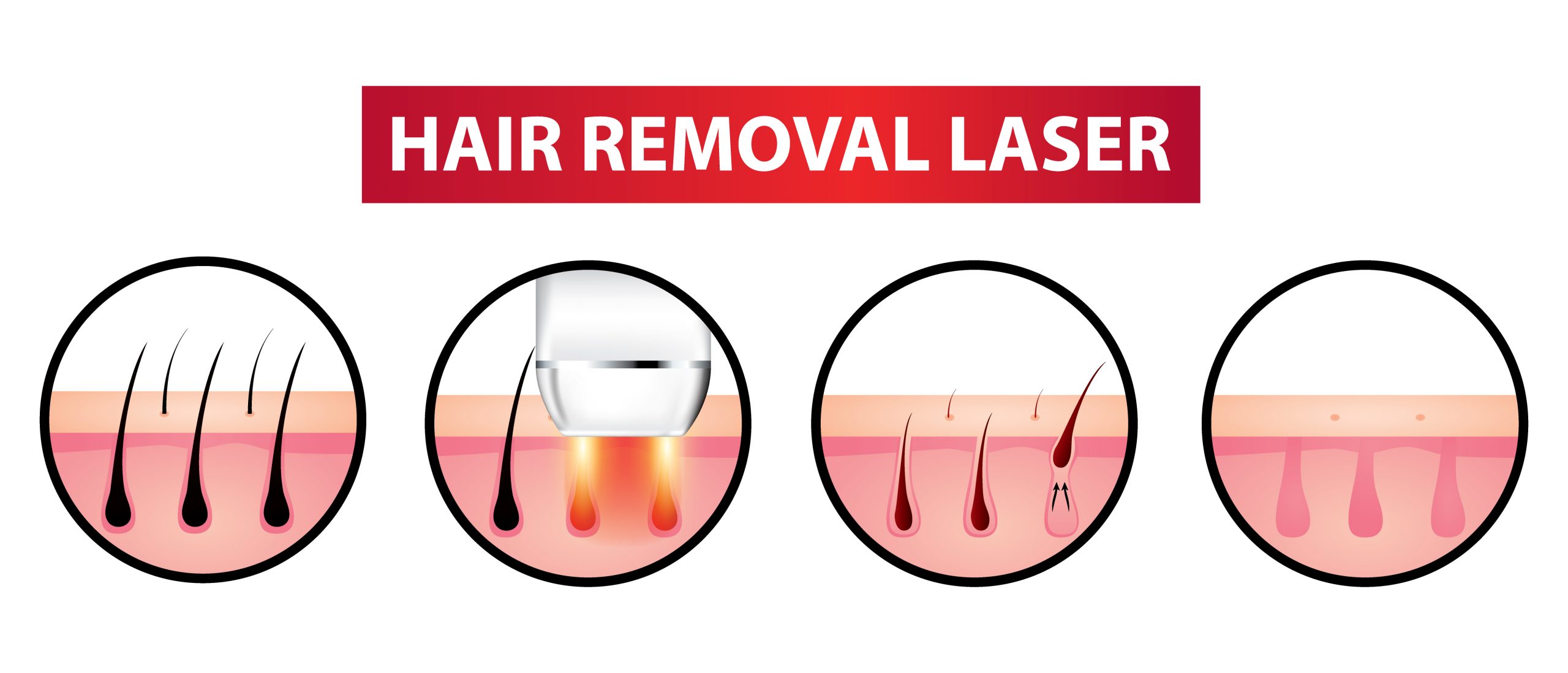 Laser Hair Removal: Procedure, Benefits, Side Effects, Results And FAQs