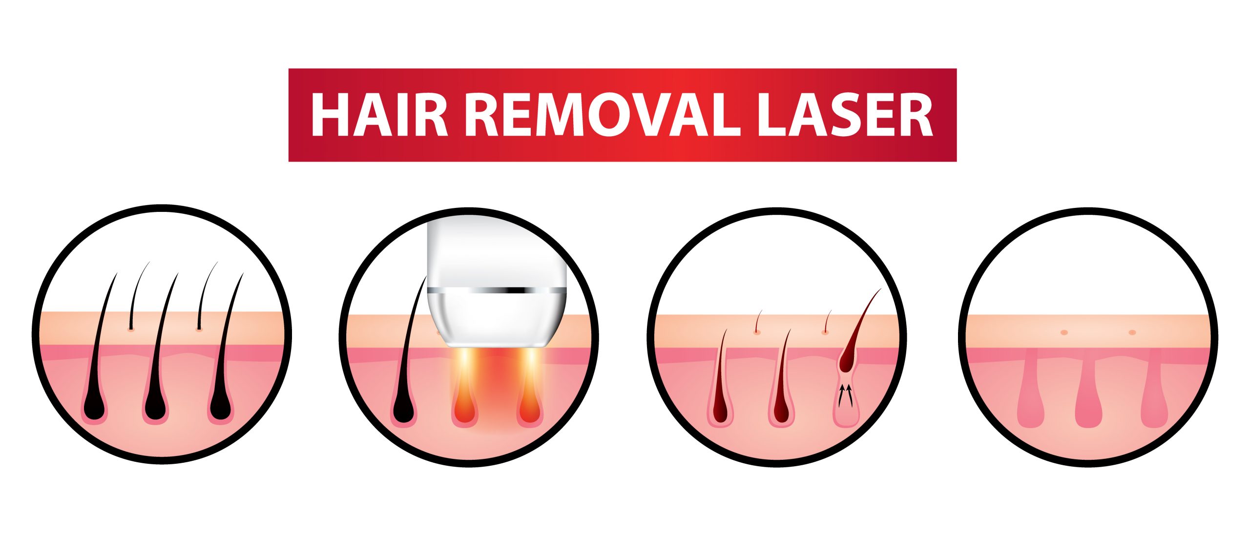 laser hair removal