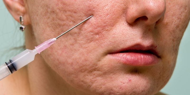 fillers for acne scars