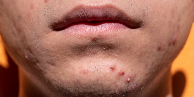 Acne Around the Mouth: Causes, Treatment, and Prevention