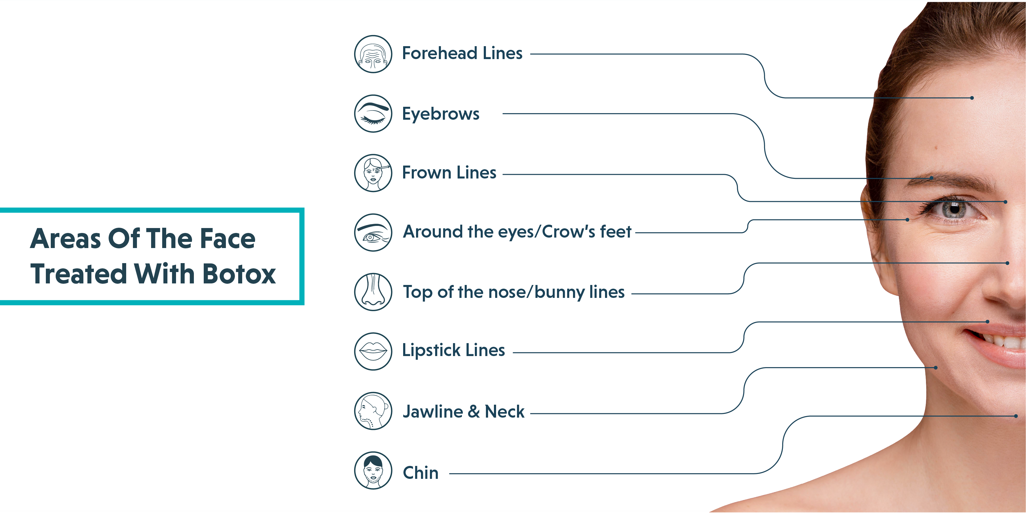 areas of the face treated with botox