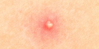 infected pimple on face