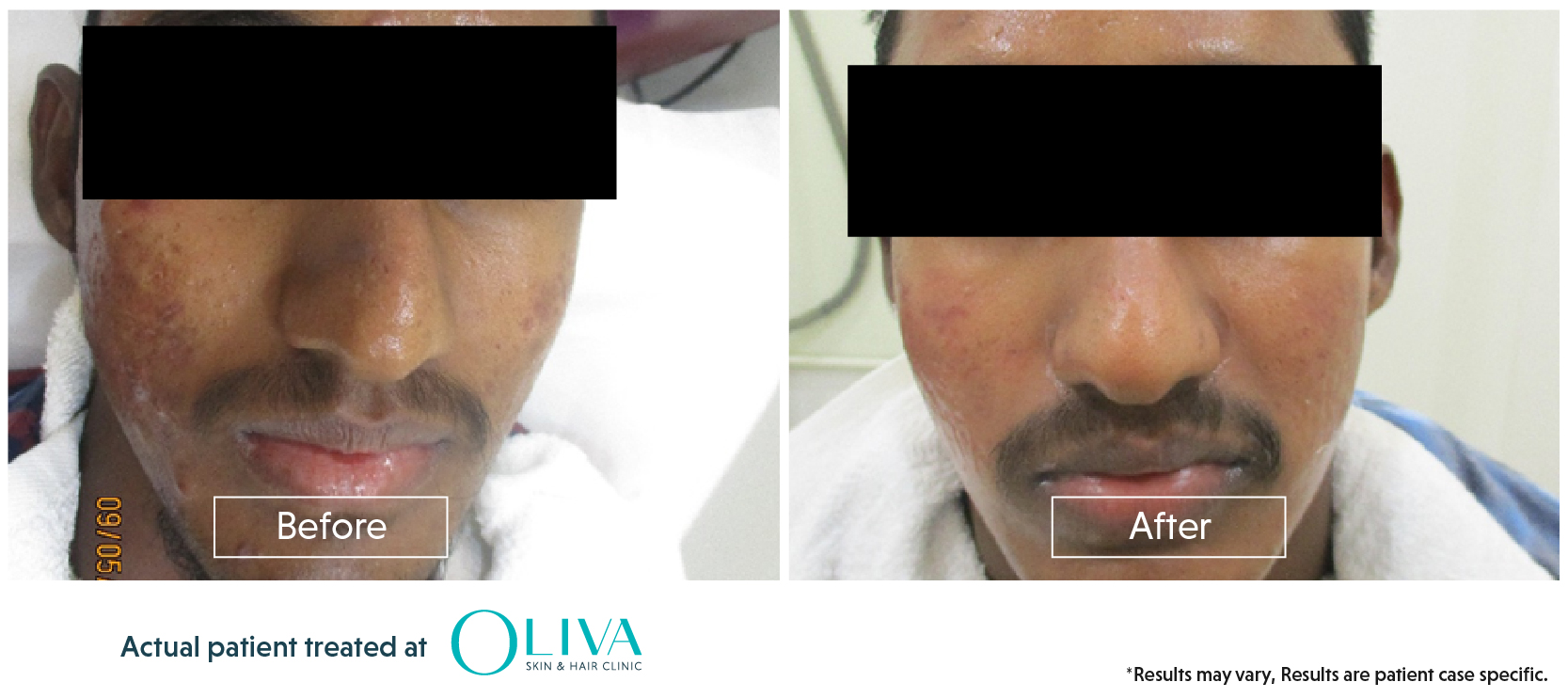 Before & After Results Of Acne Treatment