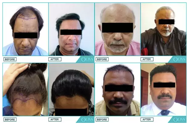 Before & After Results Of Hair Transplant Treatment