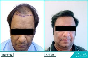 hair transplant before and after results