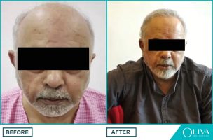 hair transplant results hyderabad