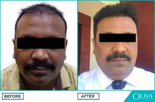 best hair transplant hyderabad