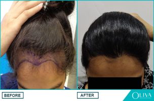 hair transplant results female