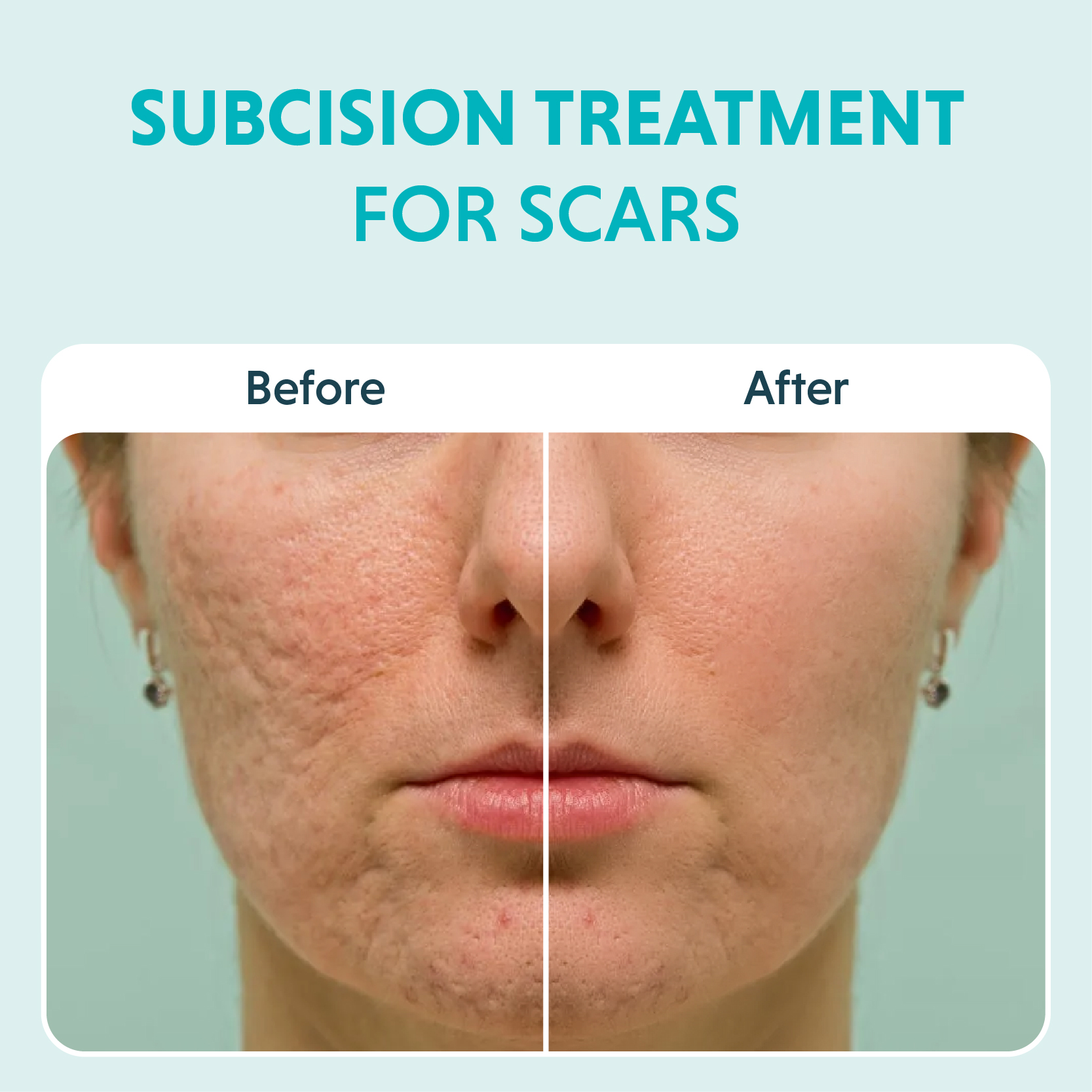 Subcision Treatment For Acne Scars: Cost, Procedure & Results