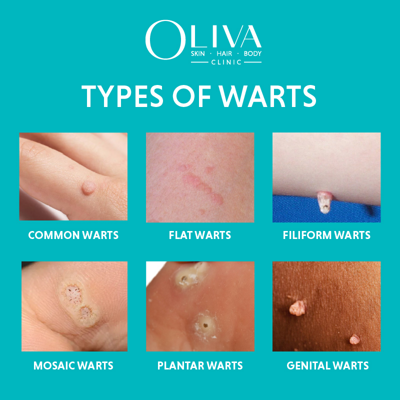 Warts Definition Symptoms Types Treatment And Prevention