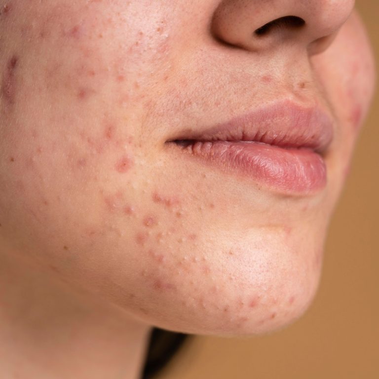 Period Acne