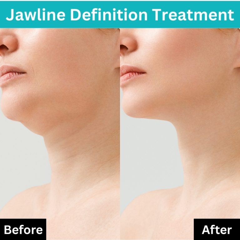 jawline definition treatment