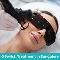 q switch laser treatment in bangalore