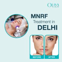 mnrf treatment in delhi