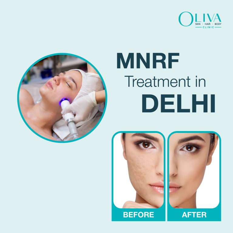 mnrf treatment in delhi