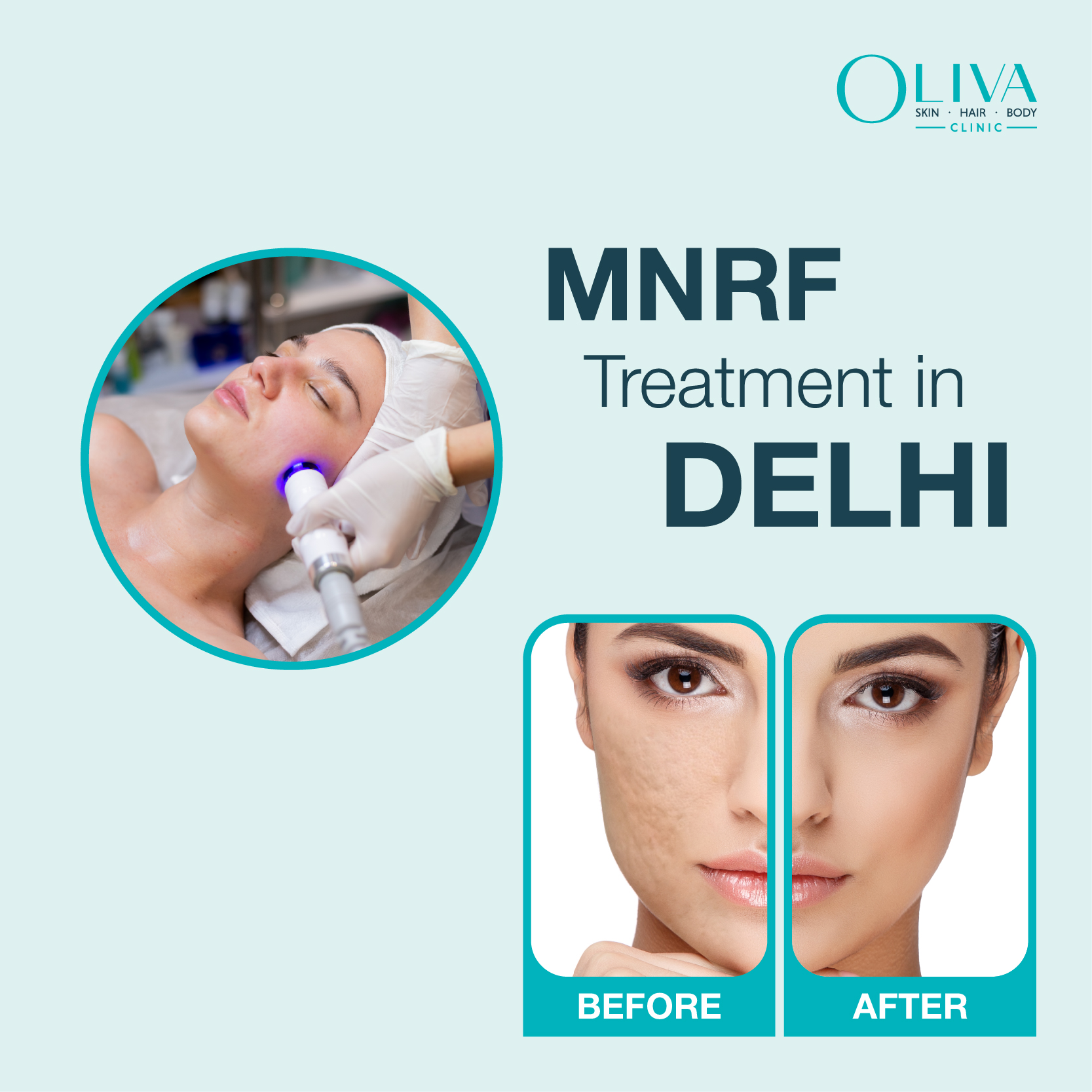 MNRF Treatment In Delhi: Cost, Results & Procedure