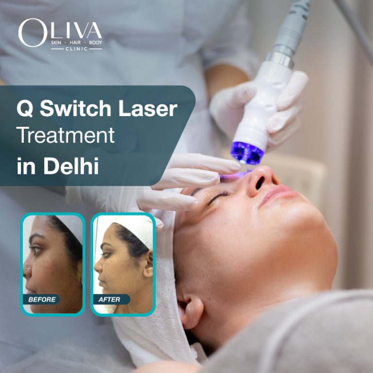 q switch laser treatment in delhi