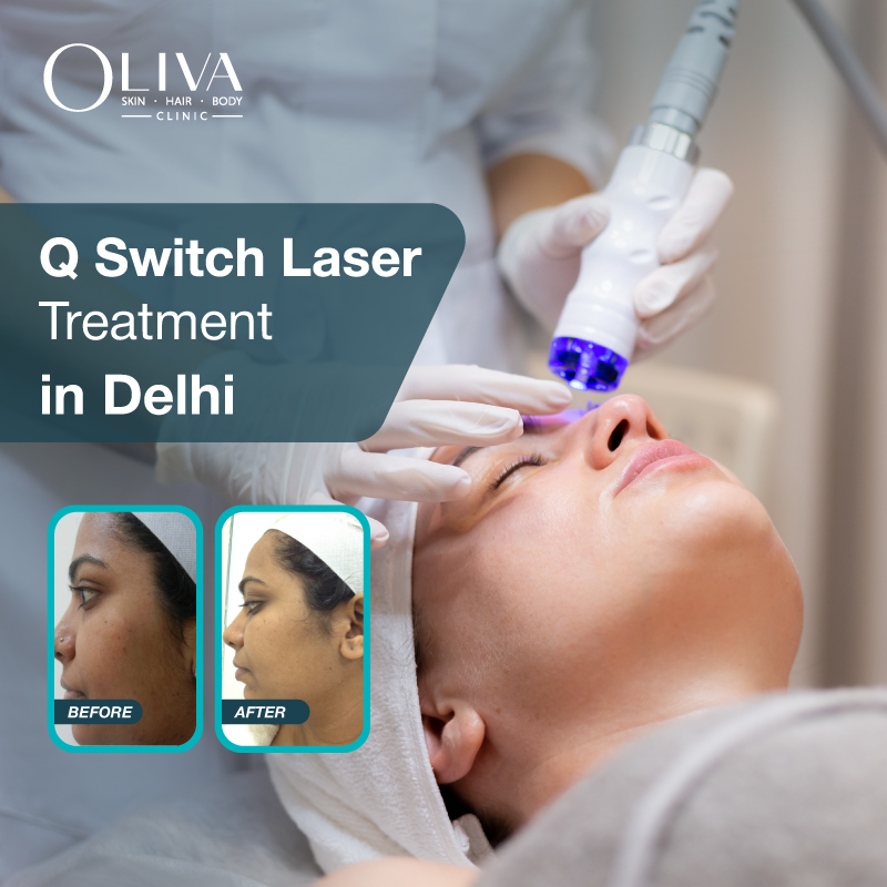 Q Switch Laser Treatment In Delhi: Cost, Results & Procedure
