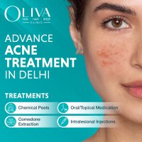 Advance Acne treatments in Delhi