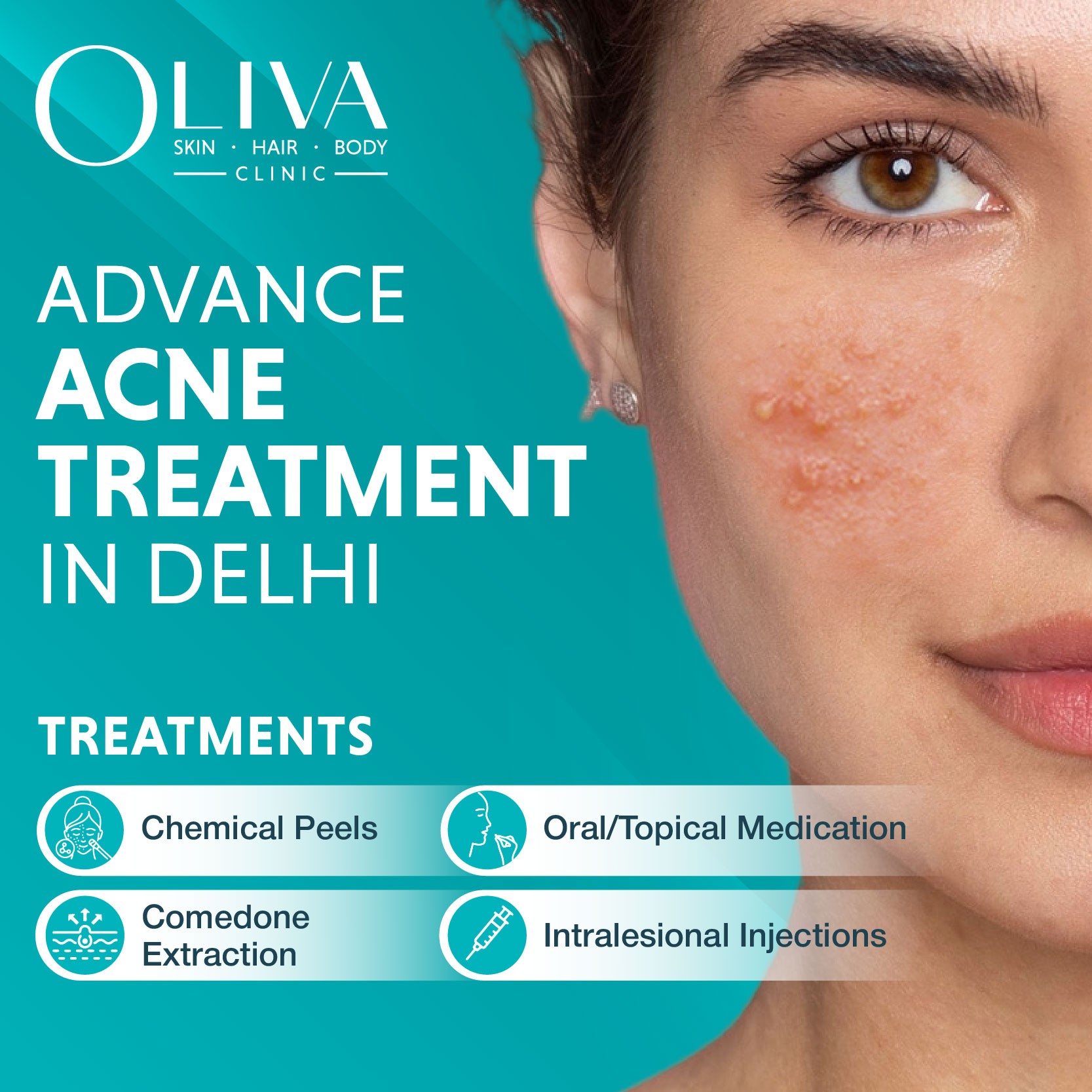 Advance Acne Treatments In Delhi: Top Dermatologist For Acne