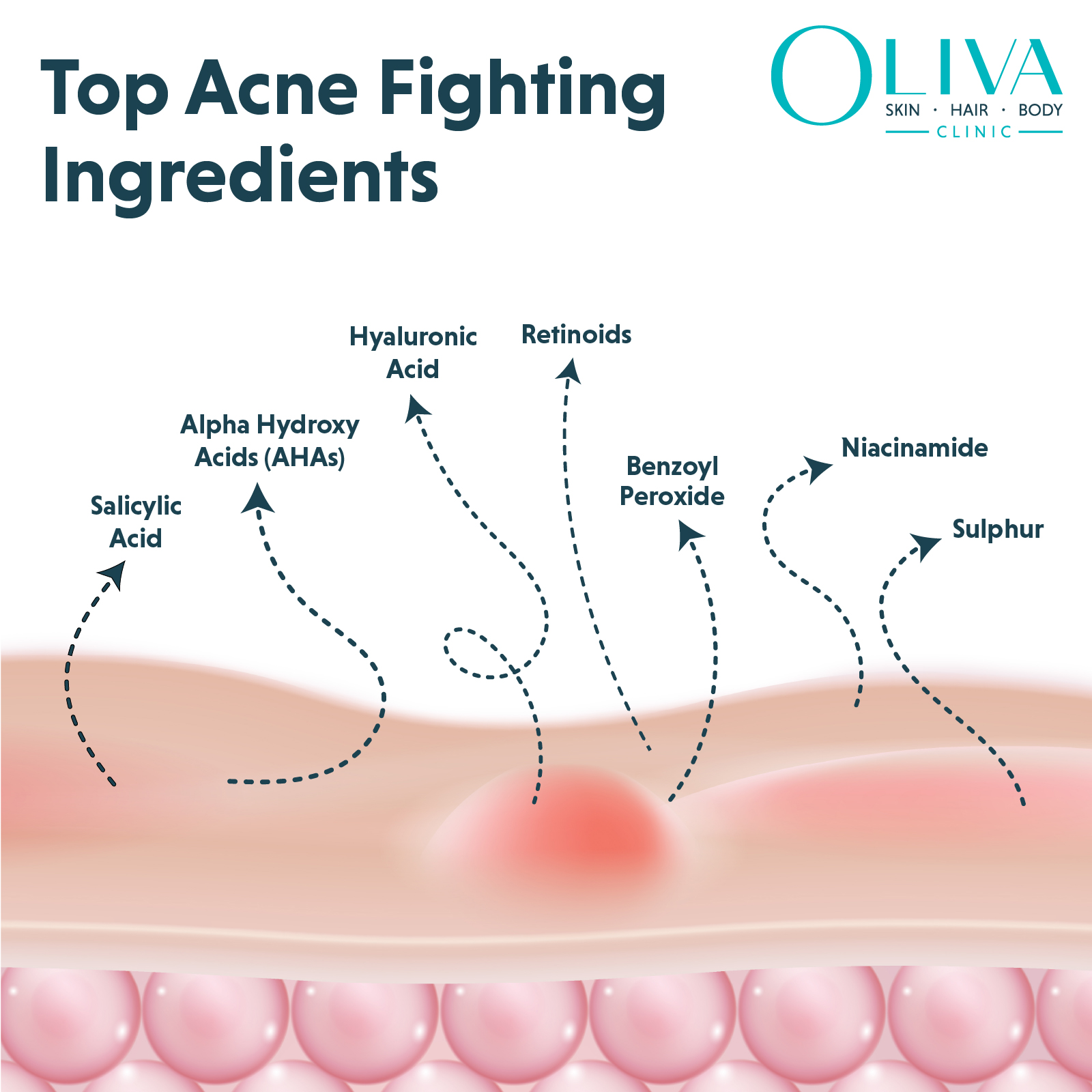 Best Ingredients to Look for in Acne-Fighting Skincare Products: Expert Guide to Clearer Skin