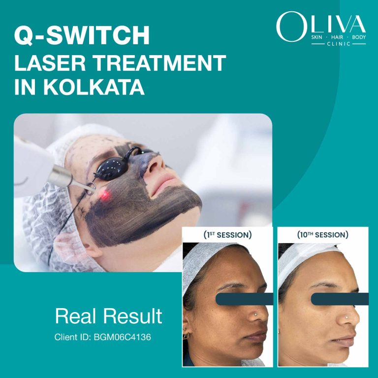 q switch laser treatment in kolkata