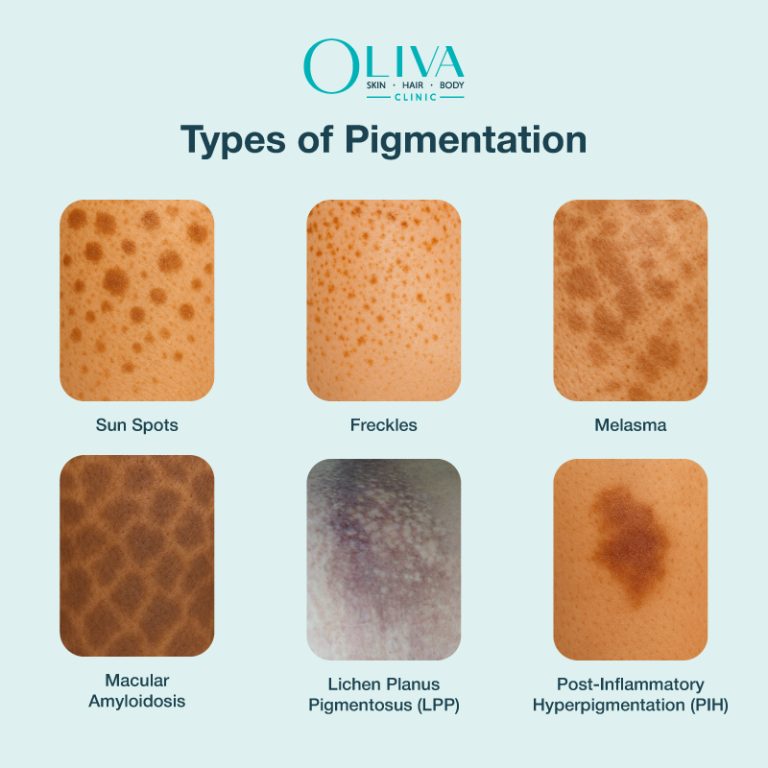 types of pigmentation