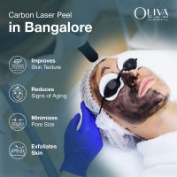 carbon laser treatment in bangalore