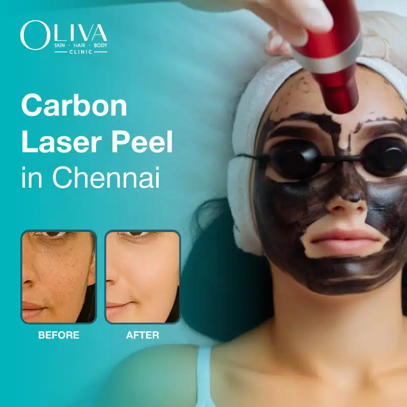 Carbon Laser Treatment In Chennai: Cost, Results, Benefits & Procedure