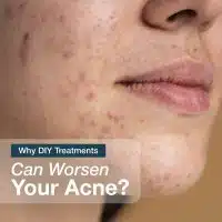 diy treatments for acne