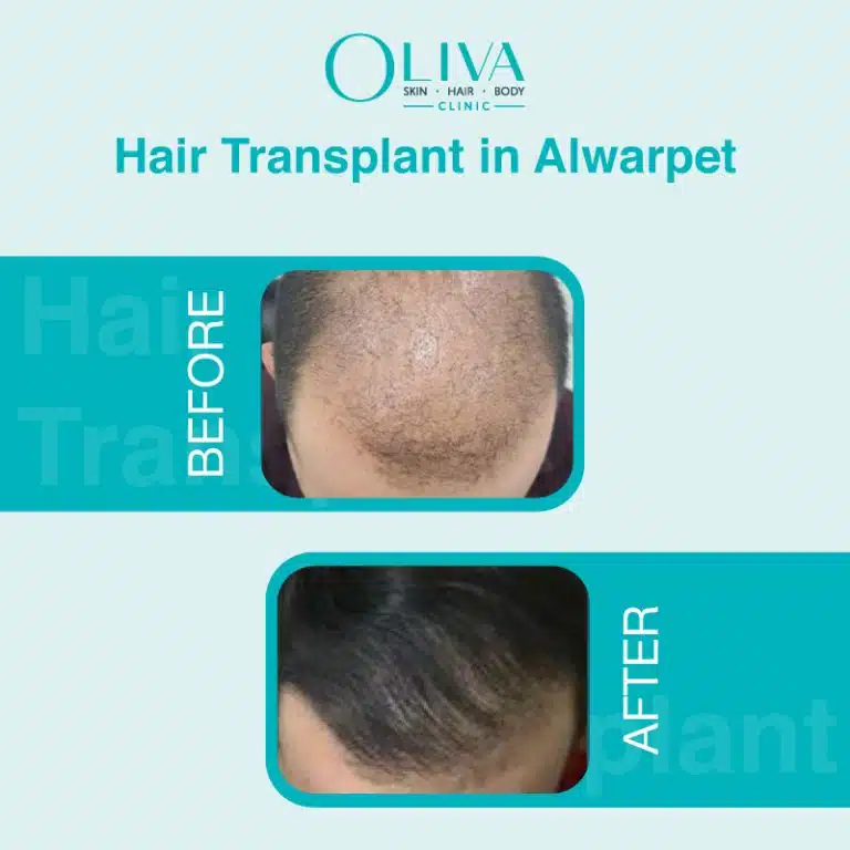 hair transplant in alwarpet