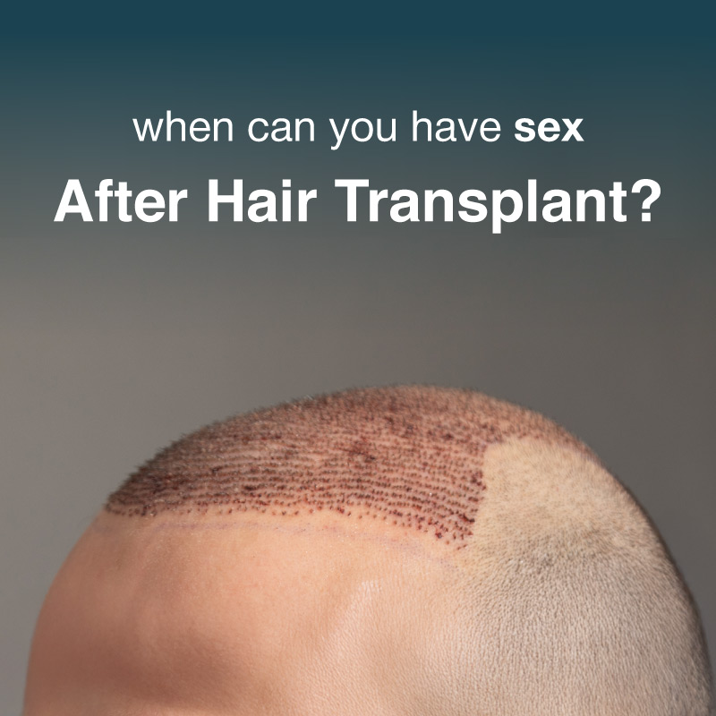 when can you have sex after hair transplant