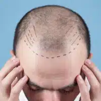 hair transplant