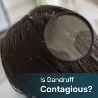 is dandruff contagious
