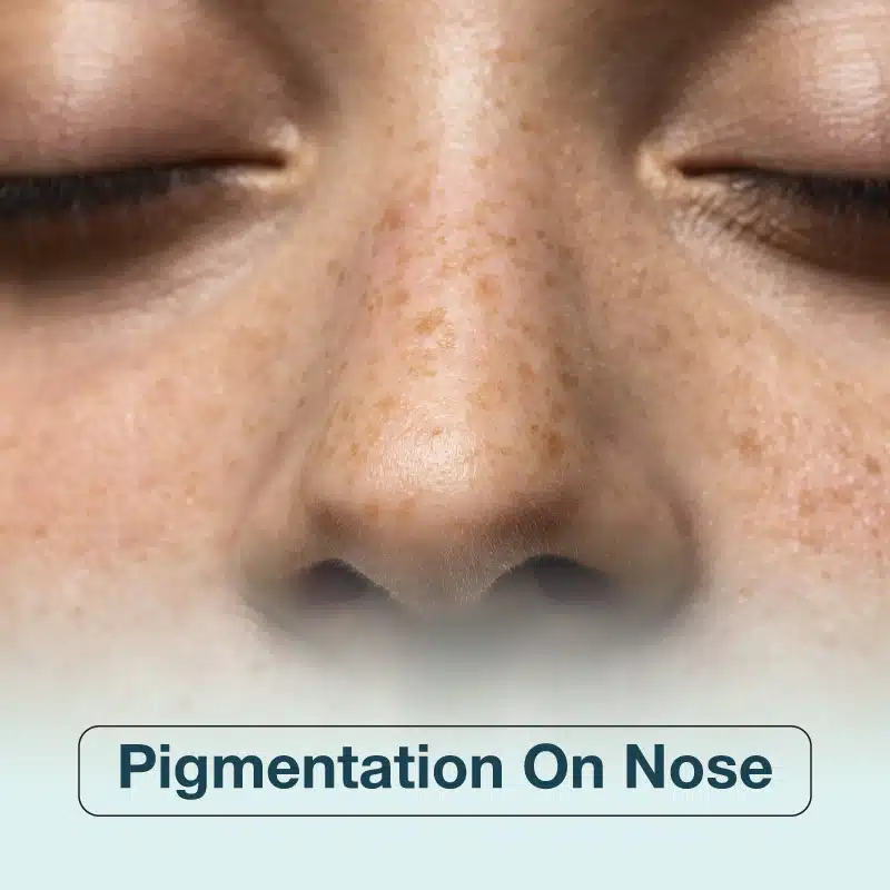 Pigmentation on Nose: Causes, Types & Best Treatments