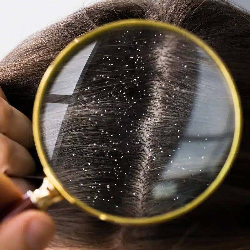 Frequently Asked Questions on Dandruff Causes | Know The Common Reasons & Expert Answers