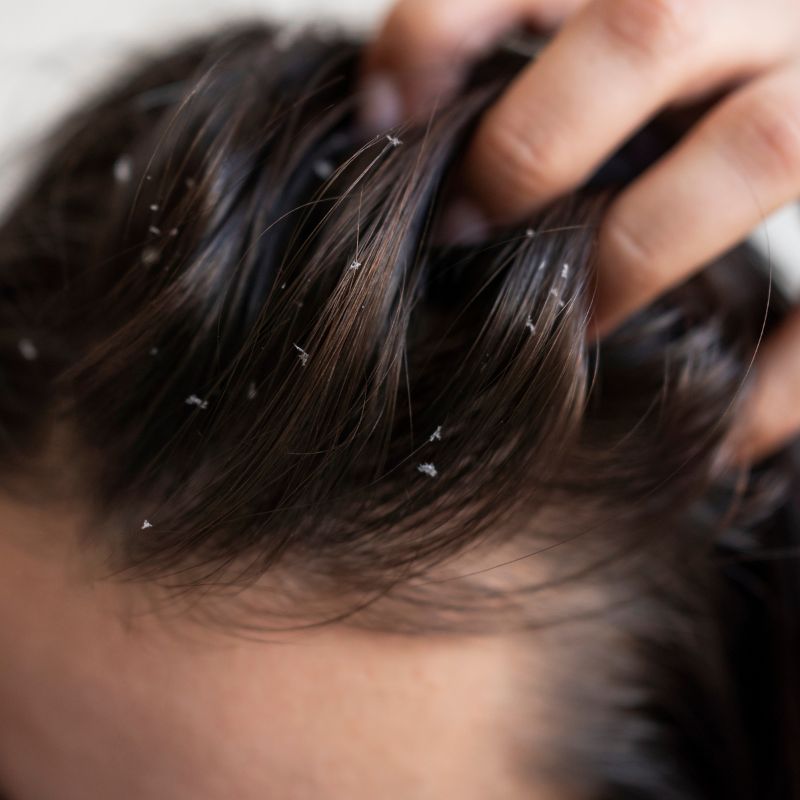 is dandruff contagious