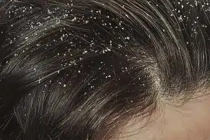 types of dandruff
