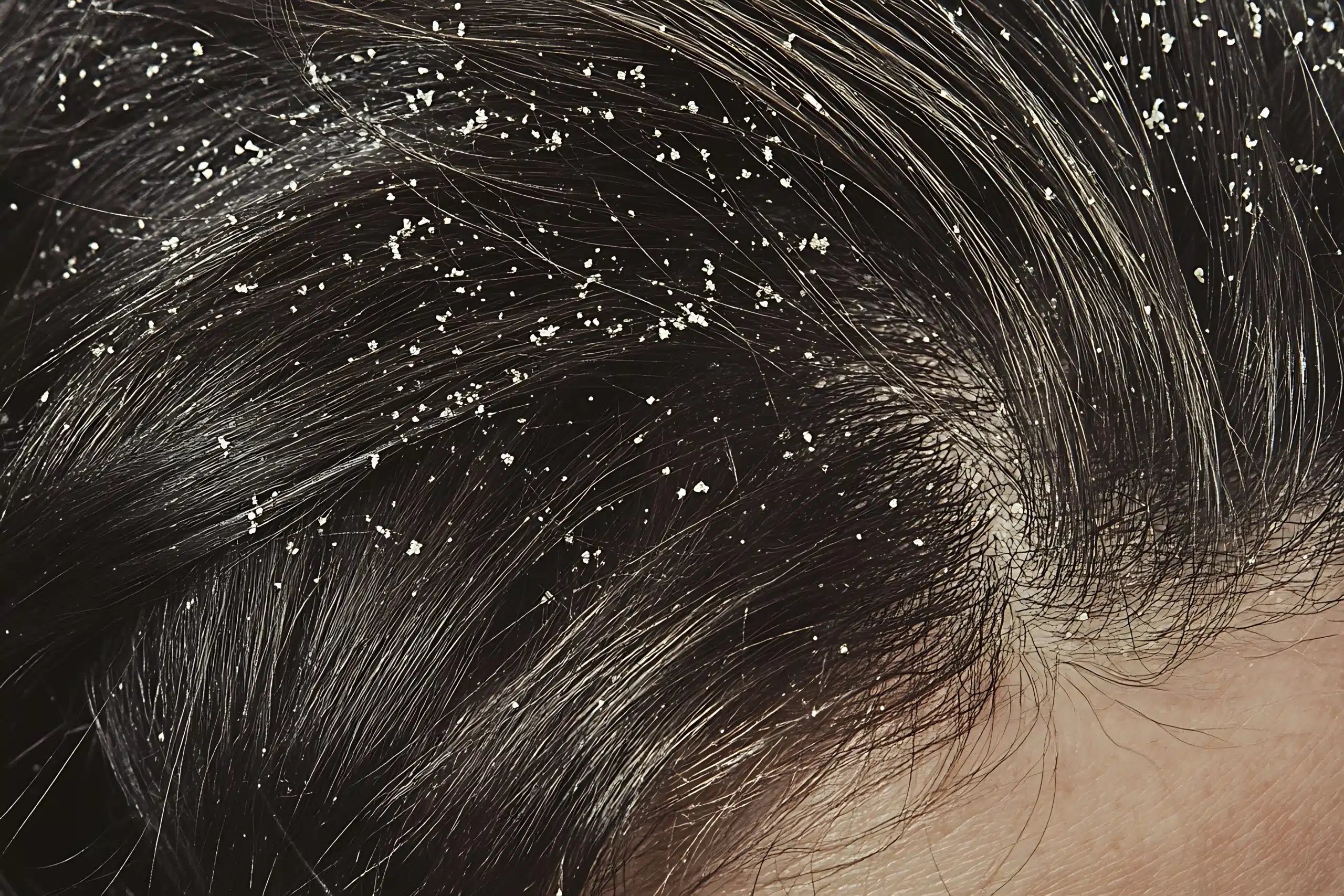types of dandruff