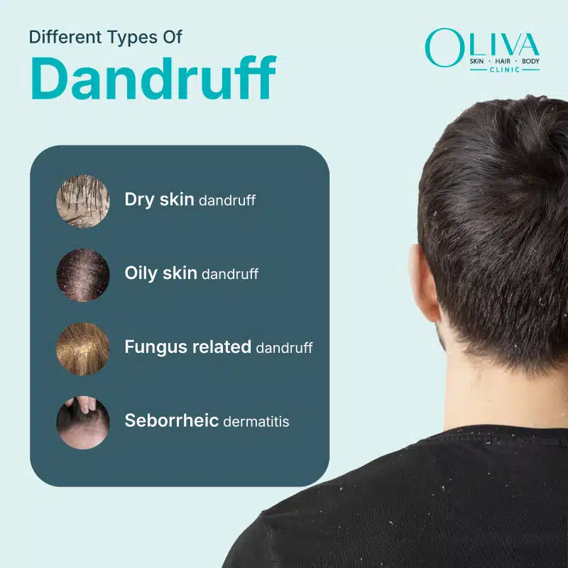 types of dandruff