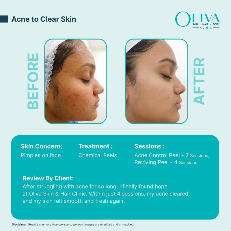 Acne to clear skin